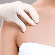 ben-nevus-tedavisi-op-dr-can-isler